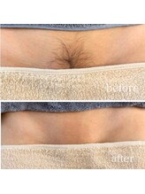 シュガーリングハウス ベル(Bell)/VIOシュガーリング