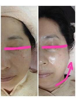 小顔エステsakura belle(サクラベル)/小顔矯正と造顔マッサージ効果