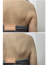 FJ/二の腕～脇肉、お背中まで◎