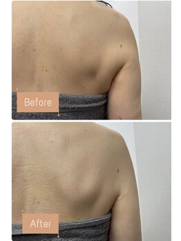 FJ/二の腕~脇肉、お背中まで◎