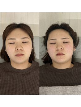 ククナ 桜木町駅前/小顔矯正(コルギ)Before＆After