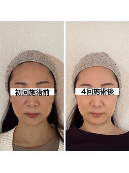 キュープ 相模原淵野辺店(Qpu)/たった4回で人生で1番小さな顔に