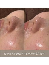 天使の艶肌 武蔵小杉店/毛穴悩みは毛穴洗浄