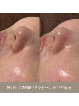 天使の艶肌 武蔵小杉店/毛穴悩みは毛穴洗浄