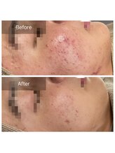 ハーブピーリング【背中 ニキビ 毛穴ケア】EMILUCA 天王寺店 /繰り返すニキビにもオススメ