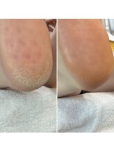 ニマ(nima)/かかとケア得意です