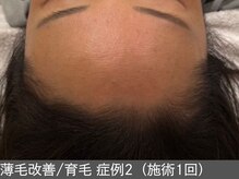 オアシスラグーン(OASIS LAGOON)/育毛促進（症例2 before）