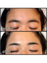 セレニティ(Serenity)/額のワックス脱毛