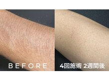 ザ サンラウンジ 長野店(THE SUN LOUNGE)/黒肌セルフ脱毛★