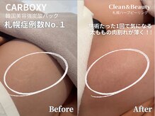 クリーンアンドビューティ 札幌(Clean&Beauty)/肉割れ妊娠線に最強炭酸パック◎
