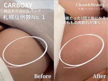クリーンアンドビューティ 札幌(Clean&Beauty)/肉割れ妊娠線に最強炭酸パック◎