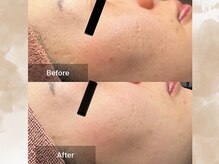 ハス(hasu.)/毛穴改善/プラズマ3回目