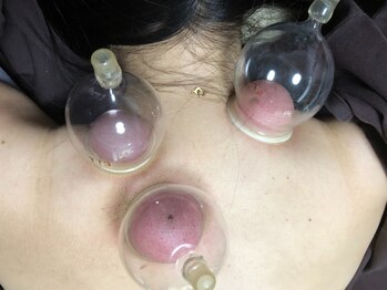 シフク鍼灸整体院/吸引カッピング