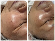 フェリス(FELIZ)/シワにはレチノールフェイシャル