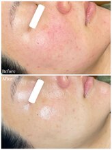 ちらちゅら/クリスティーナ＋毛穴洗浄