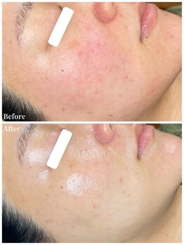 ちらちゅら/クリスティーナ＋毛穴洗浄