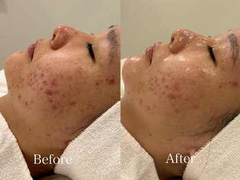 トム(Thom)/《赤み》アンストレス1回の変化