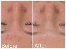 サロンドフェイス(Salon de Faith)/ハーブピーリング7回