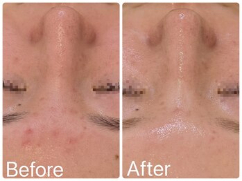 サロンドフェイス(Salon de Faith)/ハーブピーリング7回