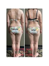 チュラ/ハイパーナイフ/所沢/痩身エステ