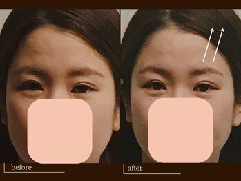 クレスト(CREST)/ビフォーアフター【小顔名古屋】