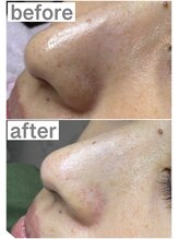 プルティティア(Pultitia)/毛穴洗浄