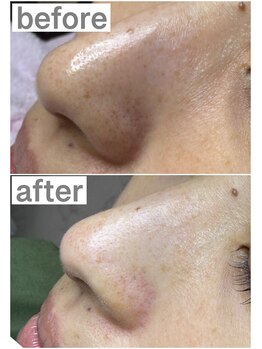 プルティティア(Pultitia)/毛穴洗浄