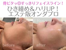 オリエンタルローザ 表参道(Oriental Rosa)/マイクロ波オンダプロ小顔リフト