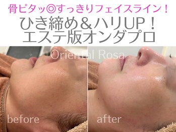 オリエンタルローザ 表参道(Oriental Rosa)/マイクロ波オンダプロ小顔リフト