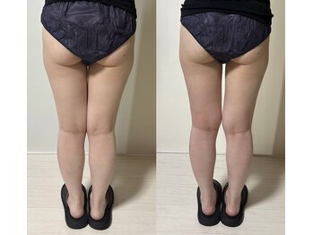 エステ リラクゼーションサロン(more)/脚集中引き締め/ダイエット