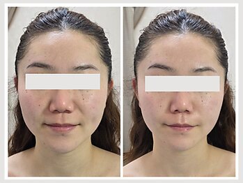 恵比寿脱毛 シーズ(She’s)/ソフトダーマ20代ビフォア