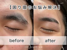 インファーマリィ(i n f i r m a r y)/困り眉のお悩み改善