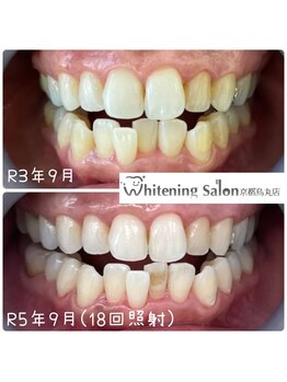 ホワイトニングサロン 京都烏丸店/ホワイトニング施術例