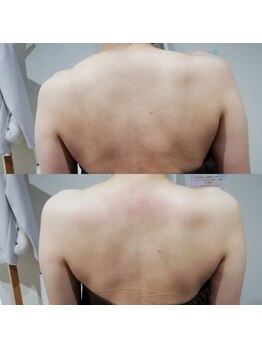 RiとBiのたまご/（ブライダル）1回before-after