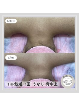 カラー(CALLA)/THR脱毛