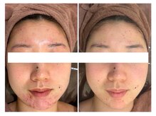 ホワイトアクア 広島店(WHITE AQUA)/ハーブピーリング/毛穴/小顔