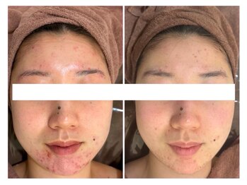 ホワイトアクア 広島店(WHITE AQUA)/ハーブピーリング/毛穴/小顔