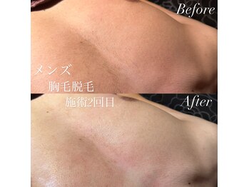 ビマナ 小岩店(NU美Mana)/メンズ胸毛脱毛
