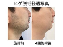 クオーレ 福津(cuore)の雰囲気（ヒゲ脱毛で清潔感アップ◎）