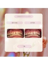 プラスビー 2号店(+b)/ホワイトニングビフォーアフター