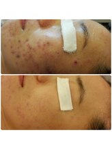 ニカ(NiCA)/2日に1回　4回照射