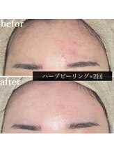 アウラ(AURA)/ニキビがキレイに♪