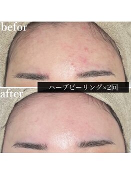 アウラ(AURA)/ニキビがキレイに♪