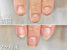 グラシュータン(gracieux temps)/【深爪矯正13000円】