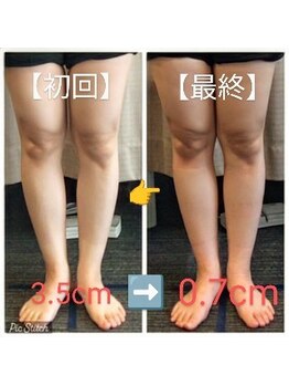 クシロ鍼灸整骨院/【O脚矯正】施術例