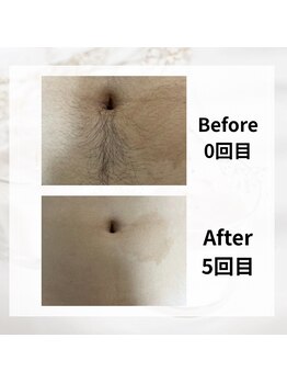 サロン ルイ(salonRui)/おへそ周り脱毛　before　afuta
