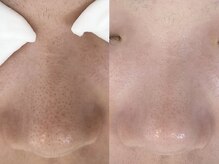 ニュートラル(neutral)/毛穴エクストラクションプロ大分