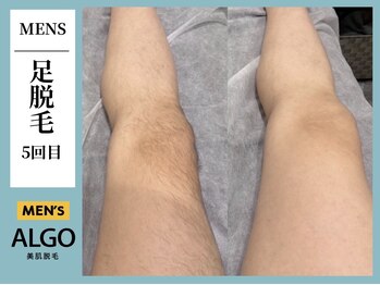 アルゴ 飯塚店(ALGO)/足脱毛