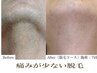 【メンズ】ヒゲ脱毛で美肌も同時に叶う♪(パック＋ヘッドマッサージ付き)