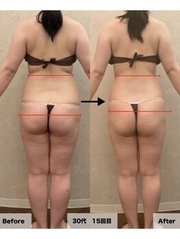 ドルチェエフェクト(dolce effect)の写真/【美脚と引き締めを叶える痩身サロン】40代の落ちない太ももとヒップの脂肪を徹底ケア！
